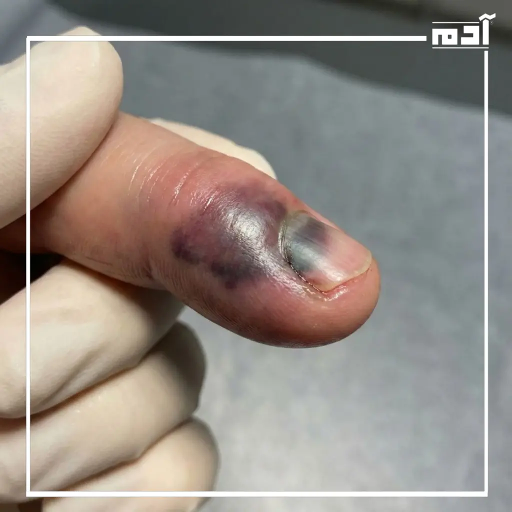 طرق علاج الإصبع المدوحس