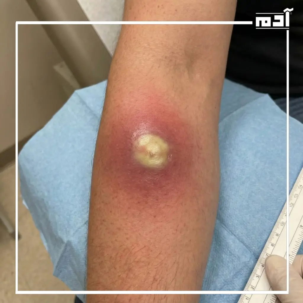 علاج القيح تحت الجلد