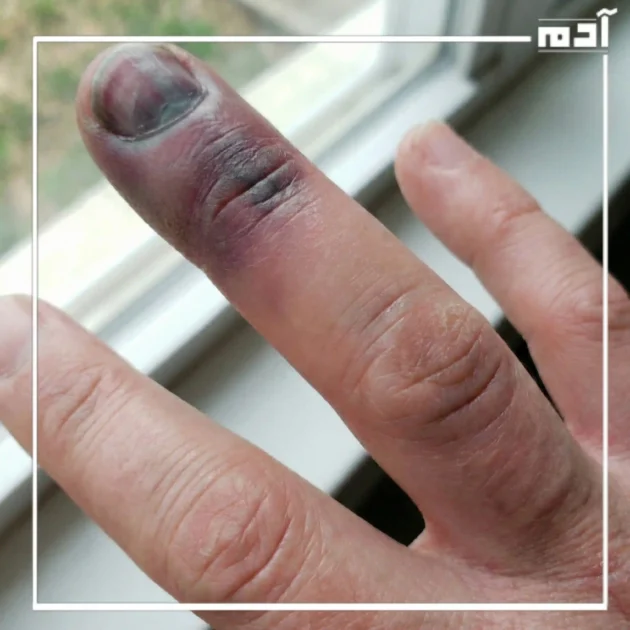 وصف دقيق لحالة الإصبع المدوحس والكدمات الداكنة